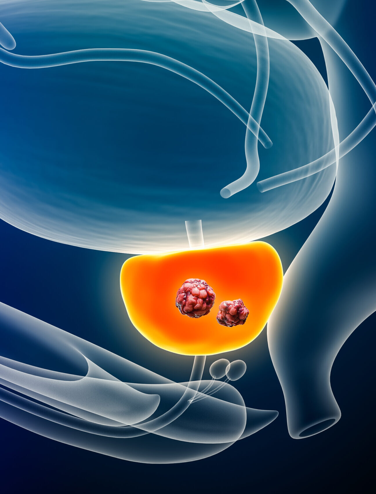 Haben Sie Prostatakrebs? Urologie Frauenfeld, Dr. med. Anja Sauck, Telefon 052 721 39 46